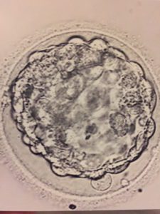 Miracle #3 IVF embryo